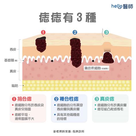 痣上面有毛|痣形成的原因？痣長毛、痣變多變大是痣病變？5招判別